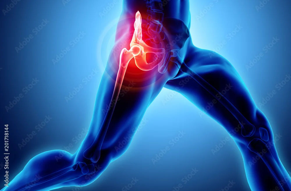 Why Does My Groin Still Hurt After Hip Replacement Surgery?
